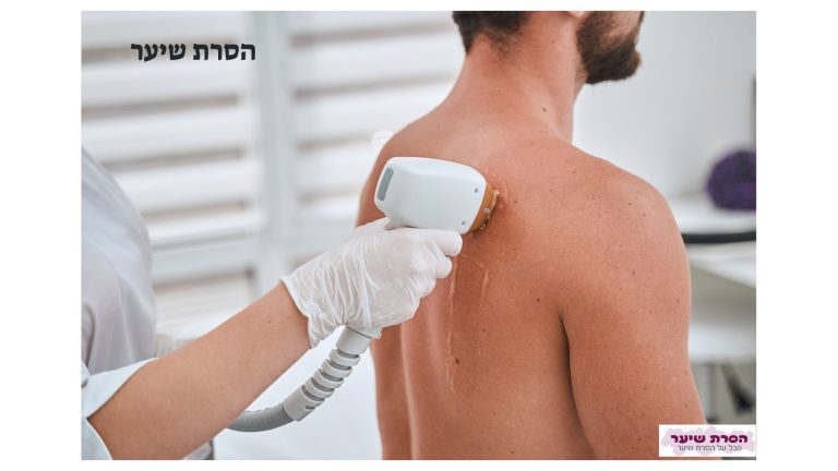 הסרת שיער